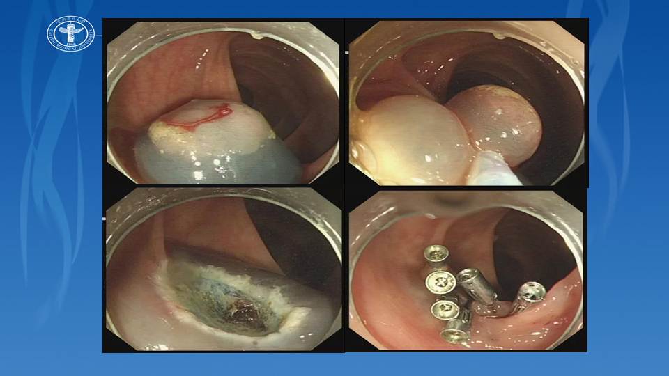 连载4结肠息肉的内镜下治疗下大肠息肉在肠镜下的规范处理及术后随访