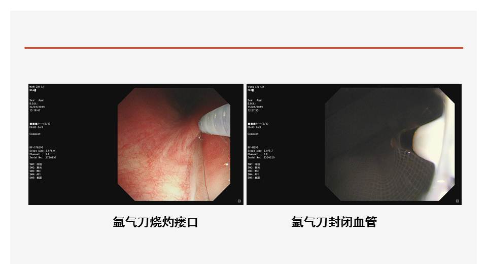 【连载】5高频电刀及氩气刀治疗