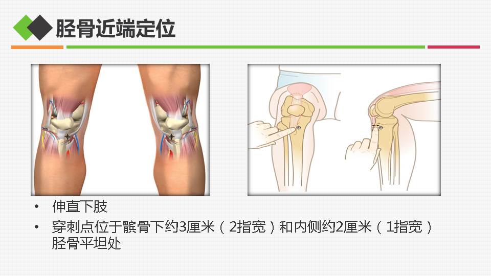 骨髓腔穿刺输液图解图片