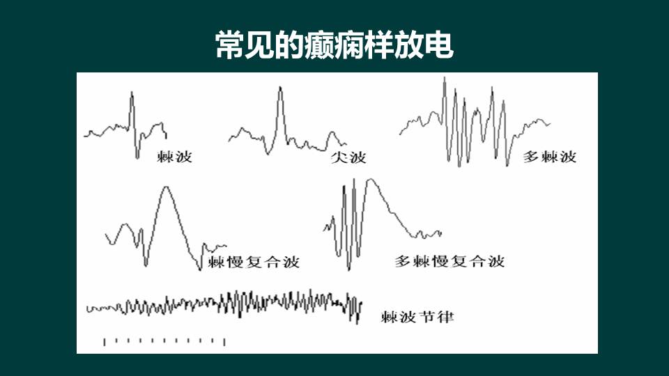 【连载 1脑电图基本知识-癫痫的规范化诊治