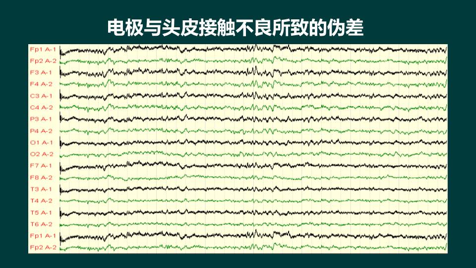 【连载】 1脑电图基本知识