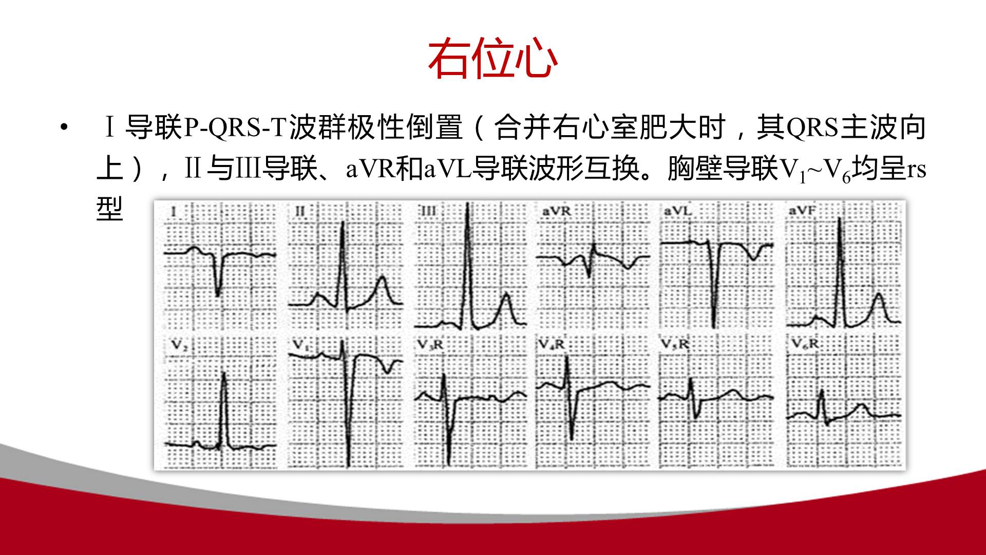 心电图avf代表什么图片